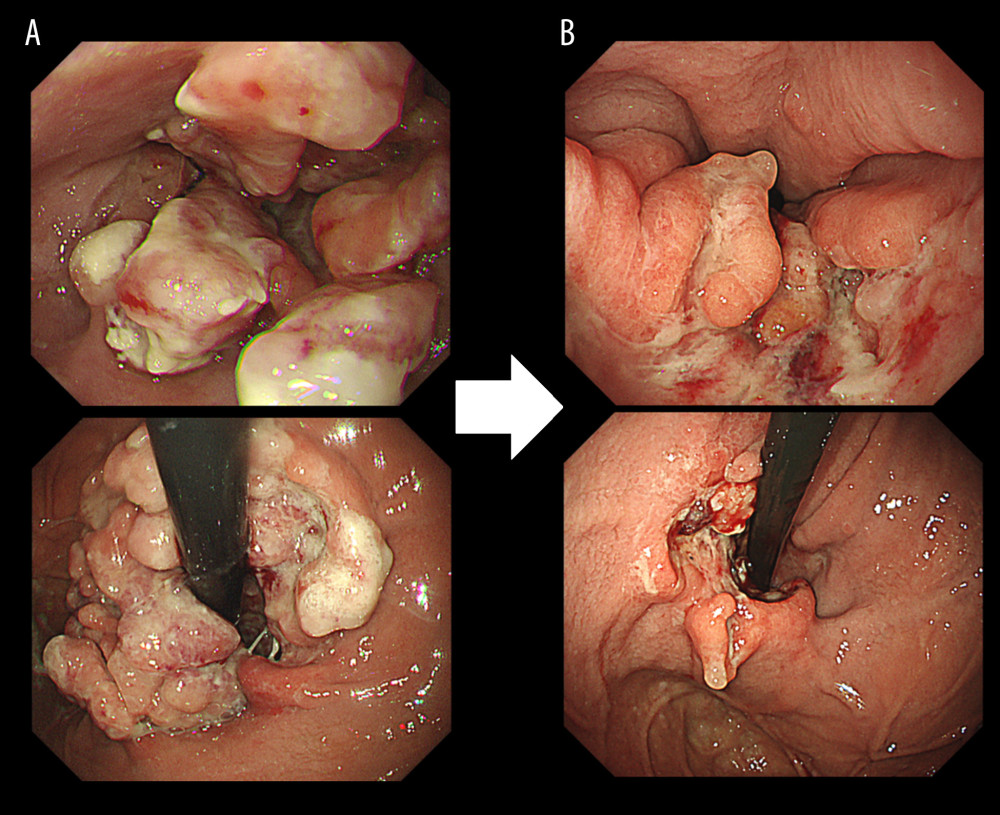 Upper gastrointestinal endoscopy. (A) Before rechallenge with trastuzumab deruxtecan (T-DXd), gastric wall thickening in the cardia of the stomach was observed. (B) After four cycles of T-DXd, shrinkage of the primary tumor was observed.