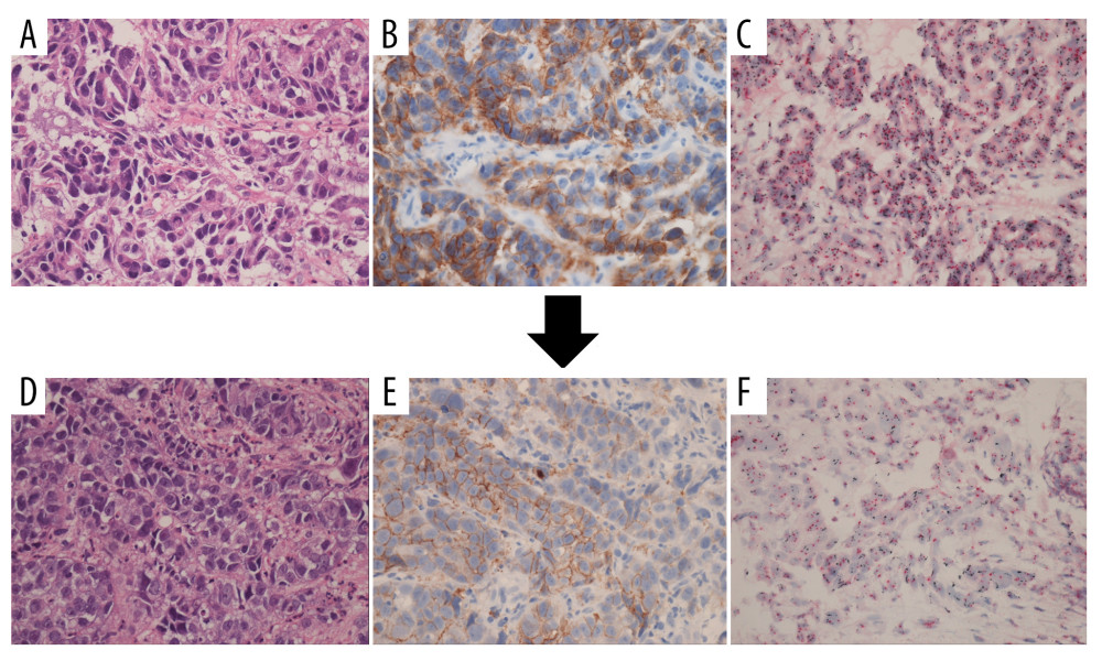 Gastric mucosal biopsy. (A) Hematoxylin-eosin staining before the rechallenge with trastuzumab deruxtecan (T-DXd): poorly differentiated adenocarcinoma. (B) HER2 immunohistochemistry (IHC) before the T-DXd rechallenge: score 2+. (C) HER2 dual-color in-situ hybridization (DISH) before the T-DXd rechallenge: HER2/chromosome 17 (Chr17) ratio, 3.76. (D) Hematoxylineosin staining after 4 cycles of T-DXd: poorly differentiated adenocarcinoma. (E) HER2 IHC after 4 cycles of T-DXd: score 2+. (F) HER2 DISH after 4 cycles of T-DXd: HER2/Chr17 ratio, 3.05.