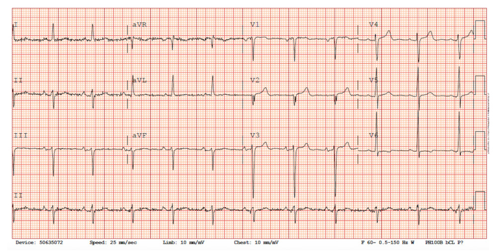 Electrocardiogram. EKG showing normal sinus rhythm with non-specific TWI in leads V5–V6.
