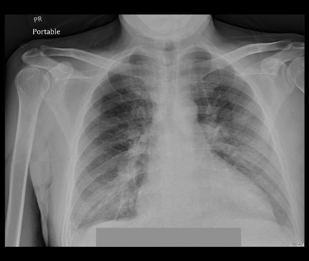 Chest X-ray. CXR showing enlarged cardiac silhouette and mild pulmonary venous congestion.