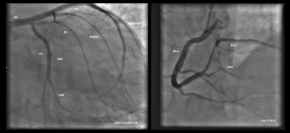 Coronary angiography. Coronary angiography revealing normal and patent coronary arteries. LAO CAUD – left anterior oblique caudal view; LAO CRAN – left anterior oblique cranial view.