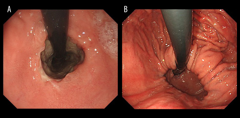 (A) Upper gastrointestinal endoscopy showing a hiatal hernia with severe reflux esophagitis on day 3 of hospitalization. (B) Upper gastrointestinal endoscopy showing a hiatal hernia with severe reflux esophagitis on day 19 of hospitalization.