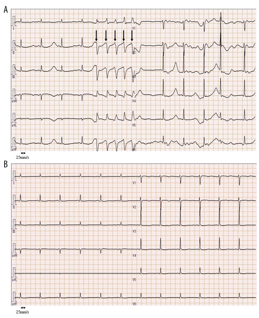 (A) An episode of pulseless ventricular tachycardia (arrow, indicating abnormal electrocardiogram findings) with marked QTc prolongation developed 29 h after the administration of parenteral nutrition at a rate of 280 kcal/day (8.7 kcal/kg/day). (B) The 12-lead electrocardiogram on the second day after admission.