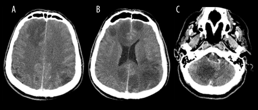 Initial CT scan (A–C) showing multiple patchy bilateral and diffuse hypodense areas at cortical and subcortical regions of occipital, parietal, and frontal lobes, and cerebellum.