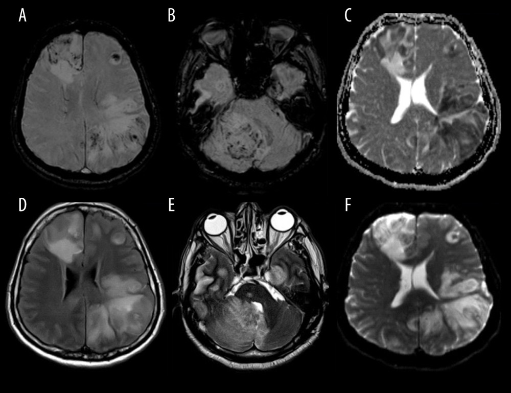 (A) Axial fluid attenuated inversion recovery (FLAIR) image showing multiple areas of abnormal hyper-intensities with associated edema and effacement of sulci bilaterally. (B) Susceptibility-weighted imaging (SWI) showing multiple areas of hemorrhagic components bilaterally in the involved portions of the cerebral hemispheres. (C, D) T2 and SWI images showing unusual involvement of the infratentorial compartment with right intracerebellar infarction and hemorrhage. (E) Diffusion-weighted imaging (DWI) showing hyperdense areas of acute infarction “restricted diffusion”. (F) Apparent diffusion coefficient (ADC) map showing dark signals indicating acute ischemia.