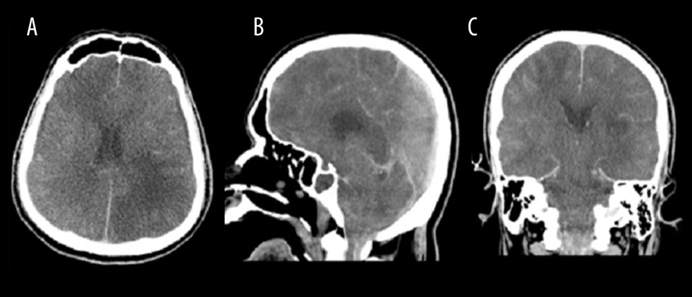 Last CT scan (A–C) on hospital day 5 showing diffuse effacement of sulci and CSF spaces with slit-like ventricles, and crowded foramen magnum, indicating brain herniation.