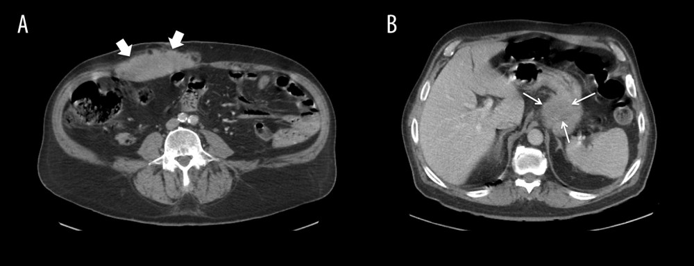 CT scan of the abdomen showing (A) a homogeneous high-density mass involving the right rectus abdominis muscle (large arrows) and (B) a focal, exophytic, ill-defined, low-density mass adherent to the gastric fundus (small arrows).