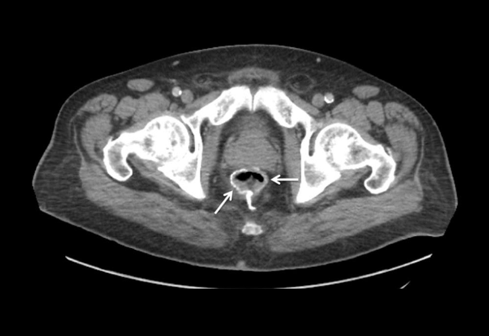 CT scan of the pelvis showing anastomotic site with staple line (Arrows) and no local tumor recurrence.
