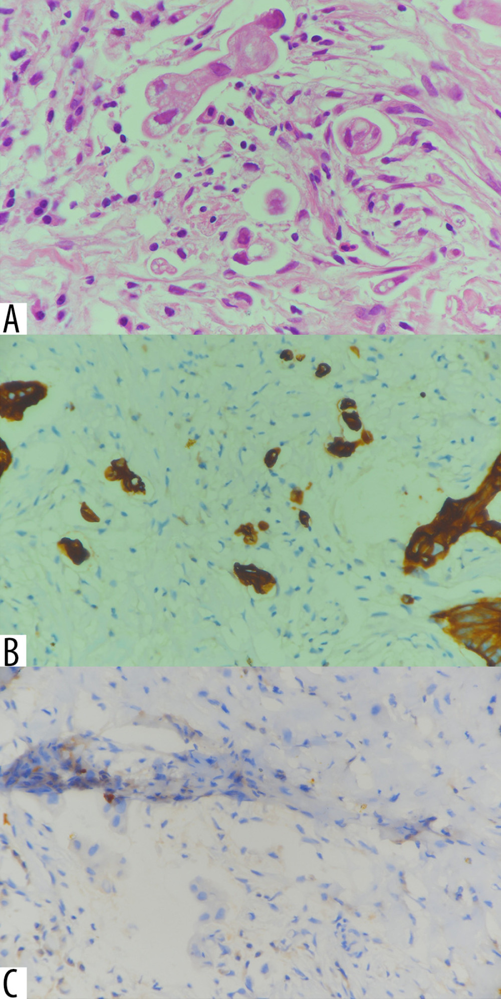 Histopathological and immunohistochemical findings of the port-site abdominal wall mass. (A) Moderately differentiated adenocarcinoma on the hematoxylin and eosin stain (H and E ×60). (B) Positive cytokeratin 7 (CK7) (×40). (C) Negative cytokeratin 20 (CK20) (×40).