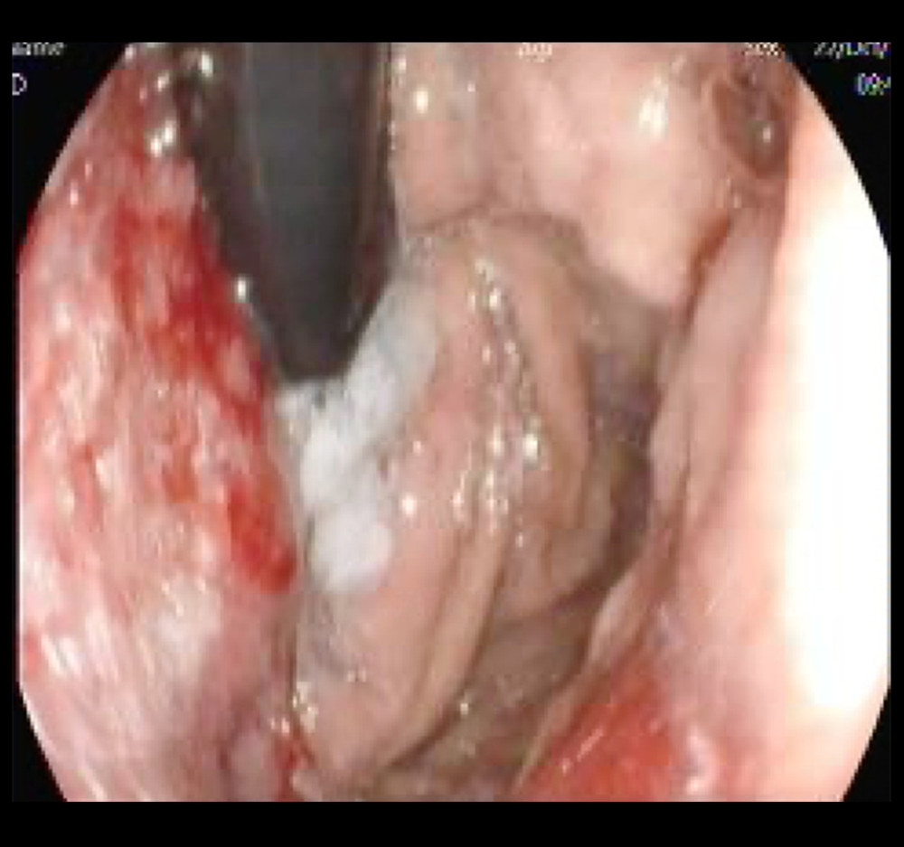 Upper endoscopy photo of a friable, erythematous gastric mass directly below the gastroesophageal junction in the lesser curvature.