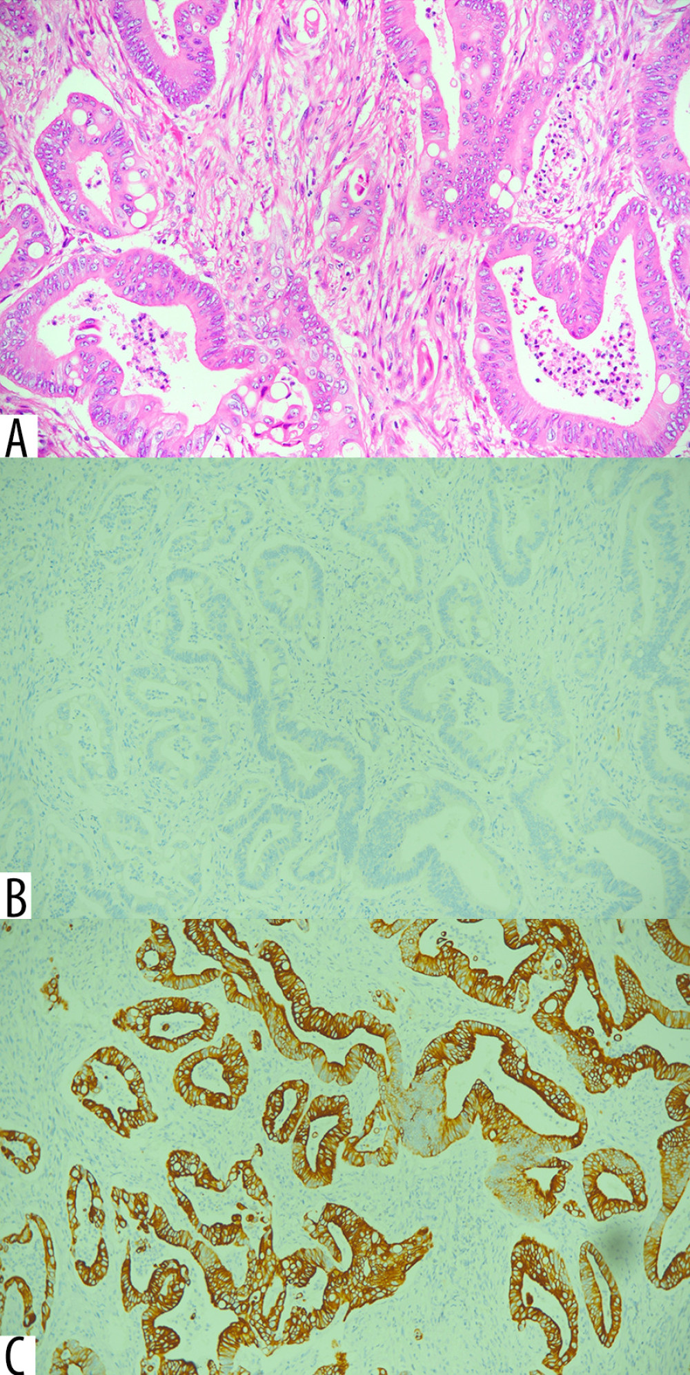 Histopathological and immunohistochemical findings of the gastric mass. (A) Moderately differentiated adenocarcinoma on the hematoxylin and eosin stain (H and E ×60). (B) Negative cytokeratin 20 (CK20) (×60). (C) Positive cytokeratin 7 (CK7) (×60).