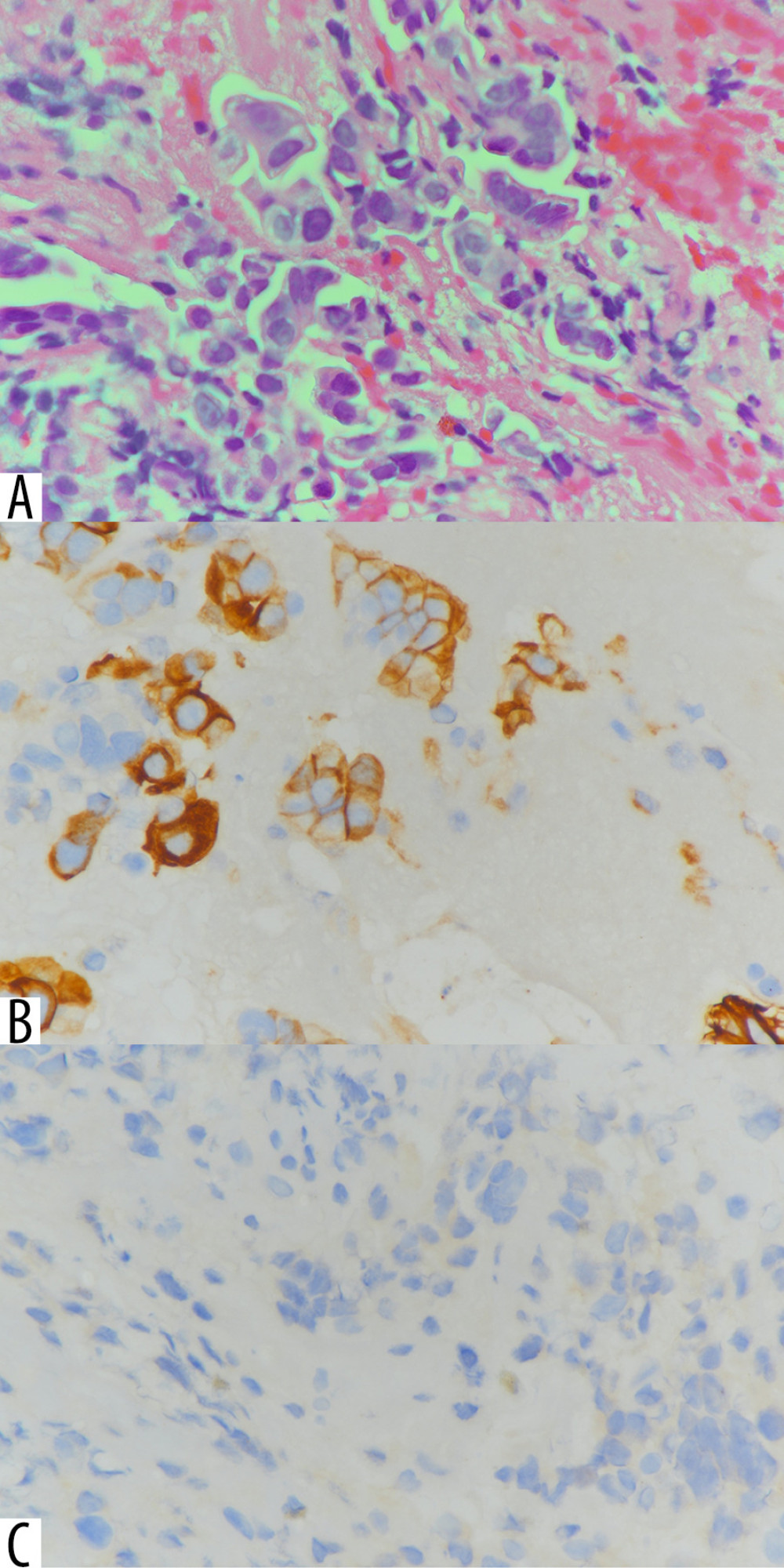Histopathological and immunohistochemical findings of rectal cancer. (A) Well-to-moderately differentiated adenocarcinoma on the hematoxylin and eosin stain (H and E stain ×20). (B) Negative cytokeratin 7 (CK7) (×10). (C) Positive cytokeratin 20 (CK20) (×10).