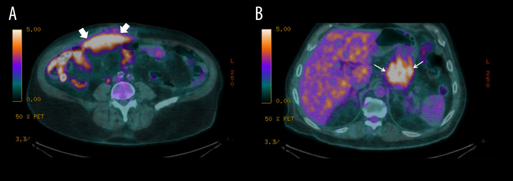 PET-CT scan showing (A) FDG-avid gastric muscle uptake (large arrows) and (B) hypermetabolic right rectus abdominis muscle mass (small arrows).