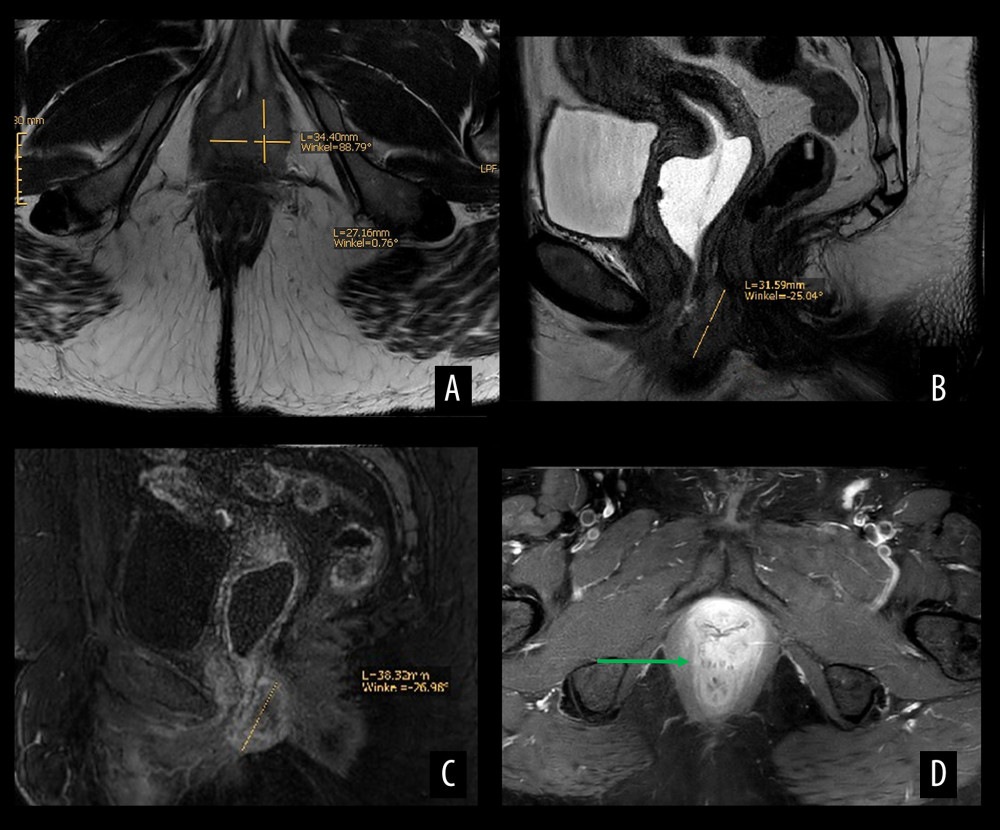 Magnetic resonance images of the paravaginal tumor. (A) Axial plane showing the tumor (with measurements) in the posterior, predominantly left, vaginal wall. (B) Sagittal plane showing the tumor (with measurements) in the posterior vaginal wall as well as its relationship to the surrounding structures. (C) Sagittal plane showing the tumor (with measurements) in the posterior vaginal wall. (D) Coronal plane showing spiculated outgrowths of the tumor extending toward the anterior rectal wall (green arrow).