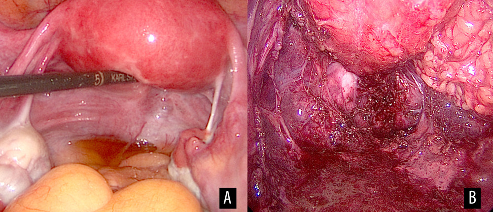 Intraoperative findings during laparoscopy. (A) View of the uterus, the bilateral adnexa as well as the pouch of Douglas. No suspicious lesions are visible. (B) View of the pelvic floor, posterior to the rectum, which is being displaced ventrally.