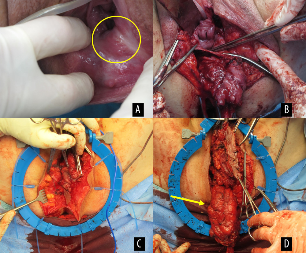 Intraoperative images of the perineal approach for the en-bloc tumor resection. (A) View of the introitus at the beginning of the operation. The caudal end of the tumor is visible on the left side of the introitus (yellow circle). (B) The tumor is being resected, first by dissecting it off the posterior vaginal wall and the pelvic floor on both sides. The external urethral orifice and the anterior vaginal wall are visible. (C) After resection of the tumor off the posterior vaginal wall, a retraction system is placed. The anus is closed by sutures. (D) En-bloc resection of the tumor together with the anus and rectum. The rectum has already been positioned outside of the pelvis (yellow arrow).