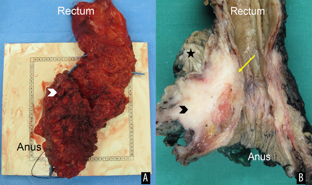 Macroscopic images of the resected specimen. (A) Unfixed specimen, directly after excision. The anus is closed by suture. The rectum is placed in a vertical orientation, corresponding to its actual position in the body. The location of the tumor is denoted by the white arrow. (B) Formalin-fixed specimen. Section through the sagittal plane with the posterior vaginal wall (black star) on the left and the rectum and anal canal on the right side of the image. The adenoid cystic carcinoma is located in the posterior vaginal wall on the left and appears relatively homogenous, with a beige-white cutting surface (black arrow). Infiltration of the muscularis propria of the anterior rectal wall can be seen macroscopically (yellow arrow).
