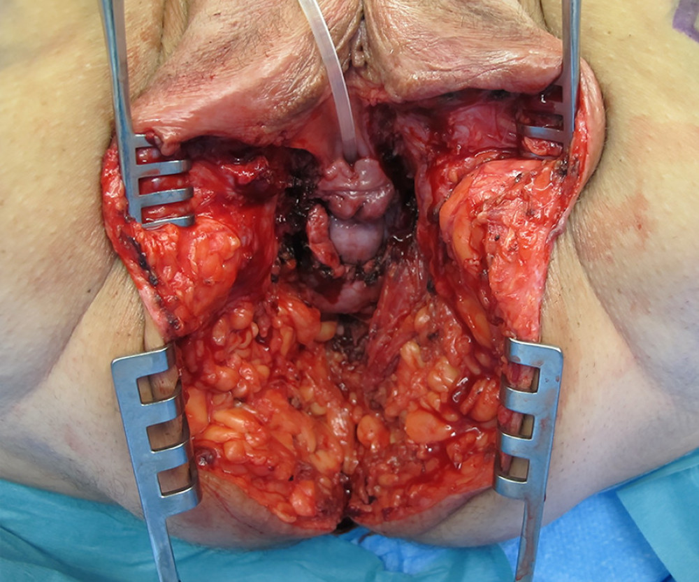 Intraoperative image. View of the vaginal, perineal, and perianal tissue defect after en-bloc tumor resection including the rectum and anus and after closure of the pelvic floor with the Permacol® surgical implant cranially to the levator ani muscles. The surgical field is held open by a retraction system. The bladder catheter is in place.