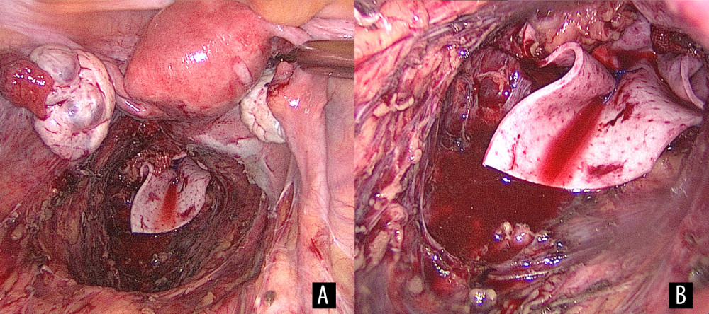 Intraoperative images. (A, B) Laparoscopic view of the closure of the pelvic floor by means of Permacol® surgical implant.