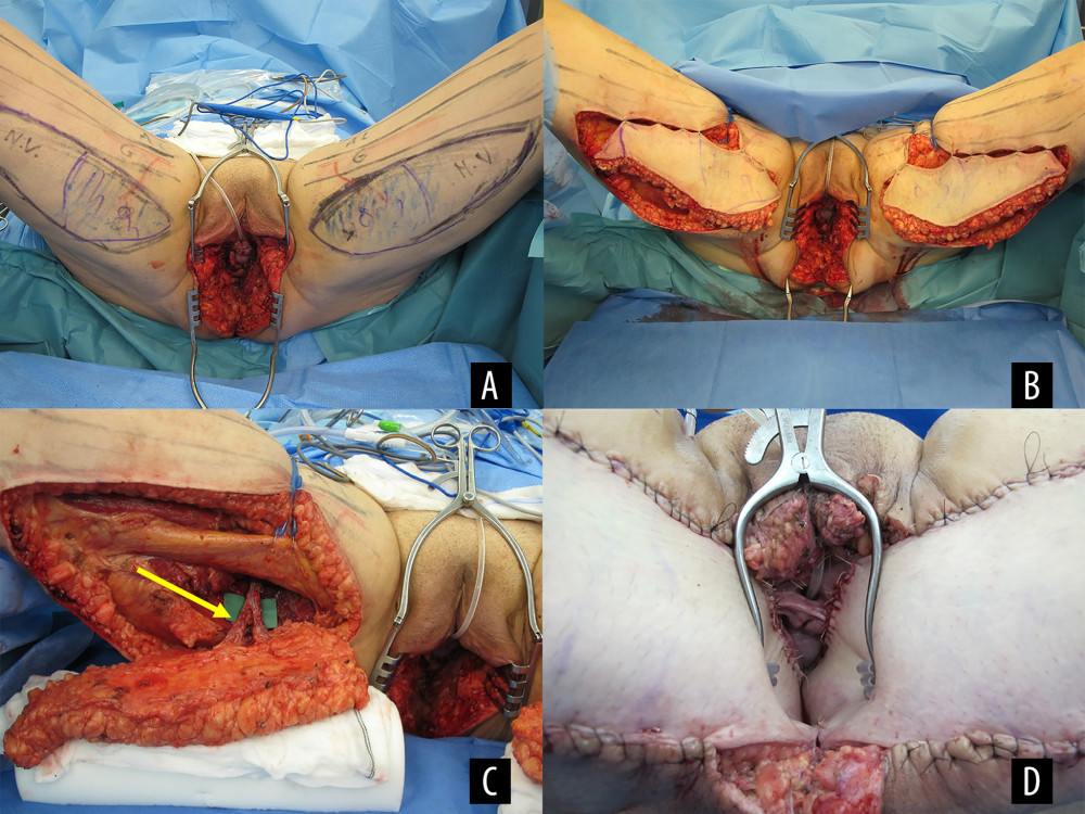 Intraoperative images during the reconstructive surgery. (A) Vaginal, perineal, and perianal tissue defect after en-bloc tumor resection. The intended posteromedial thigh (PMT) flaps are marked on both sides. (B) Incisions to excise the flaps are made on both sides. (C) The PMT flap on the right side is prepared, the vascular pedicle is fully dissected (yellow arrow). (D) The PMT flaps are sutured in place to reconstruct the vagina. The labia and the perineum have not yet been reconstructed and adapted.