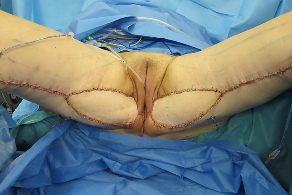Intraoperative image after completion of the reconstructive surgery by means of bilateral posteromedial thigh flaps.