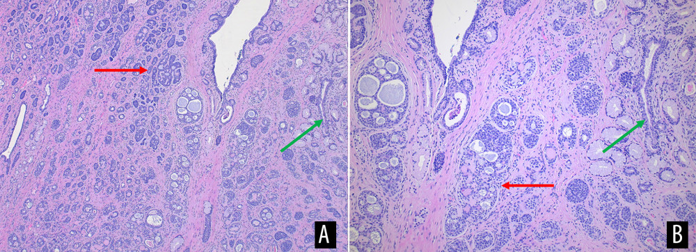 Microscopic findings. (A) Hematoxylin and eosin staining, 50× magnification: lobule of the Bartholin’s gland (green arrow) adjacent to infiltrates of the adenoid cystic carcinoma (red arrow). (B) hematoxylin and eosin staining, 100× magnification: lobule of the Bartholin’s gland (green arrow) adjacent to infiltrates of the adenoid cystic carcinoma (red arrow).
