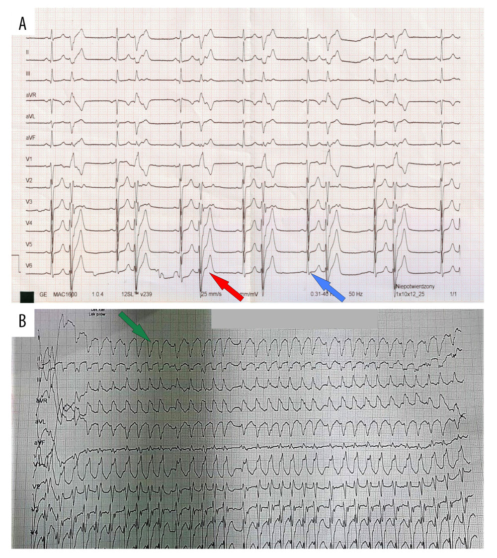 Electrocardiography of the patient with ventricular electrical storm (VES). (A) Electrocardiography recorded prior to the 3 weeks of the incident (red arrow – ventricular bigemina; blue arrow – sinus beat). (B) Electrocardiography at admission to the Emergency Department (green arrow – ventricular tachycardia).