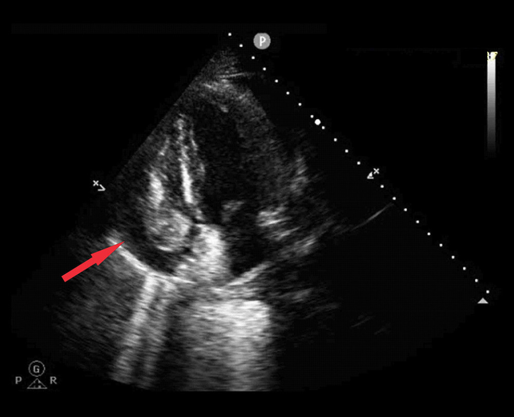 Echocardiography of the patient with ventricular electrical storm (VES) with a pericardial tamponade after ablation with radiofrequency current: Echocardiographic apical 4-chamber view shows pericardial effusion (red arrow).