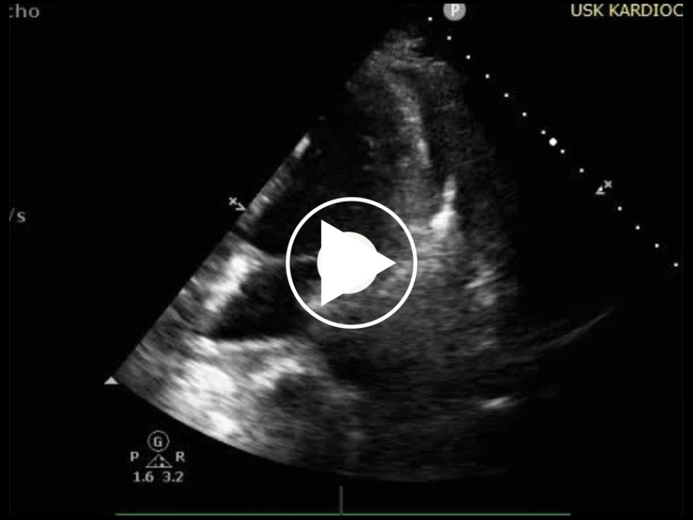 Echocardiography of the patient with ventricular electrical storm (VES) with a pericardial tamponade after ablation with radiofrequency current. Echocardiographic apical 4-chamber view displaying a pericardial effusion.