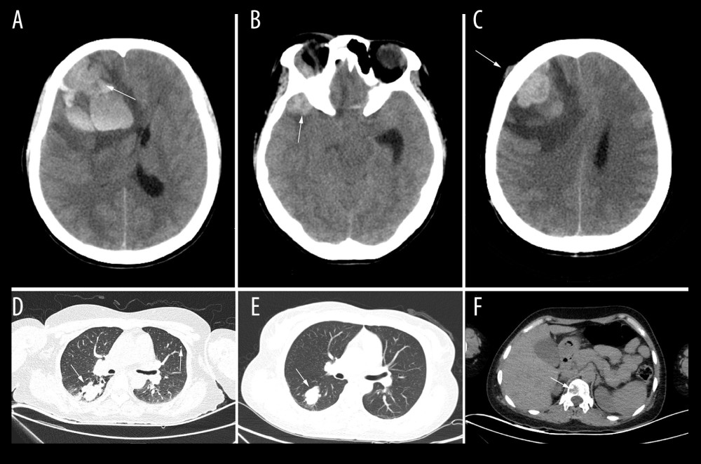 Preoperative head and lung computed tomography (CT) showed late cerebral metastasis of melanoma. (A) Right frontal melanoma brain metastasis with intracranial hemorrhage compressing the brain severely to the contralateral hemisphere (white arrow indicates the tumor). (B) Another metastasis located at the right temporal lobe (white arrow indicates the tumor). (C) Cutaneous tumor at right frontal scalp (white arrow indicates the tumor). (D) Foliate mass measuring 3.7×2.6×3.3 cm in the lower lobe of right lung. Small round nodules scattered in both lungs (see white arrows). (E) Lung CT scan taken 5 years earlier indicated an isolated mass in the lower lobe of right lung (see white arrow). (F) Suspected metastasis in the 12th vertebra (see white arrow).