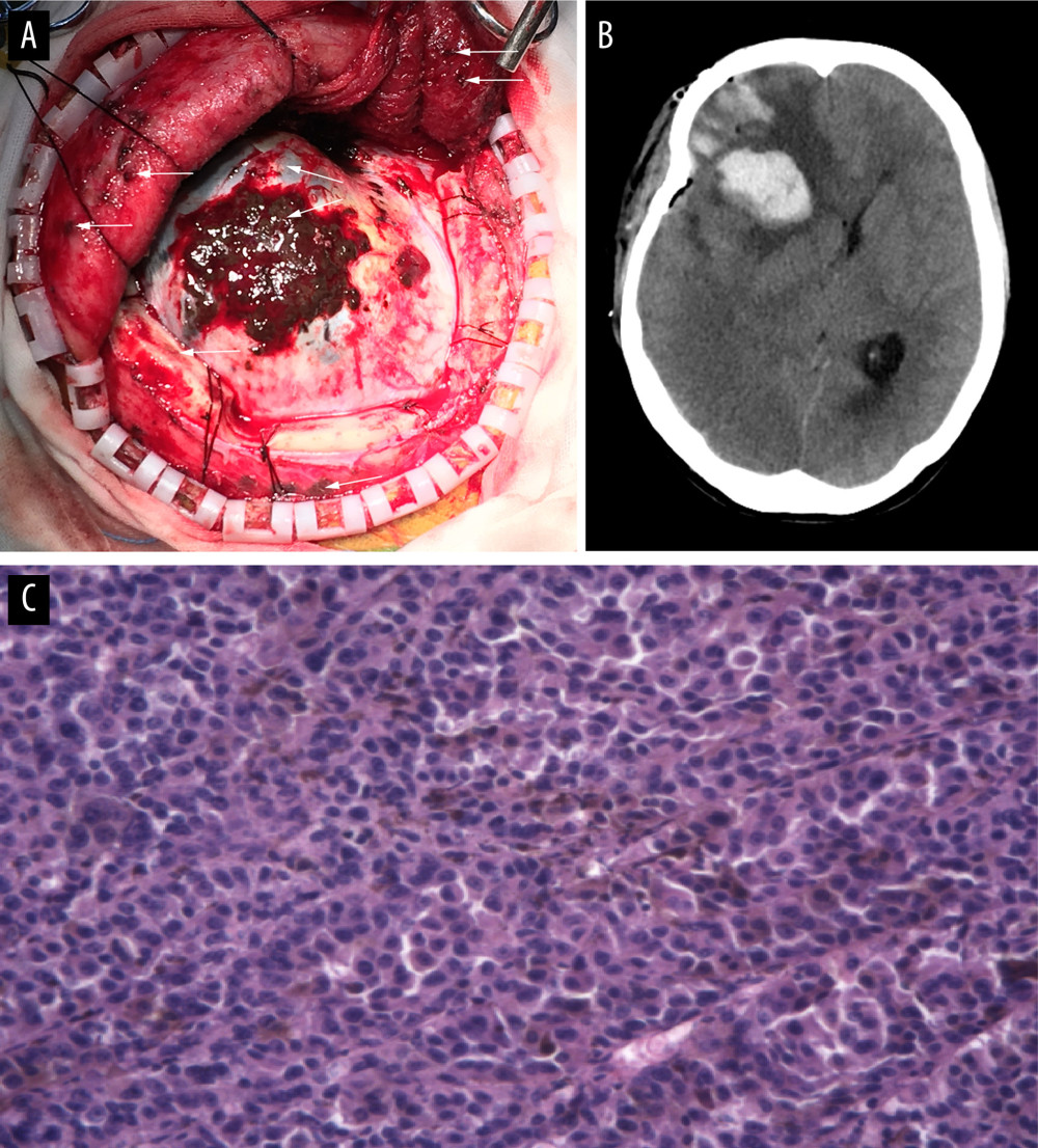 Late cerebral metastasis of melanoma presents widespread dissemination in dural matter and adjacent temporal bone, temporalis and hypodermis. (A) The extradural part grew infiltratively through the skull to subcutaneous tissue. Small melanic dots were disseminated in adjacent temporal bone, temporalis, and hypodermis (white arrows indicate the tumor). (B) Postoperative head CT scan revealed a recurrent intracranial hemorrhage in the right frontal lobe. (C) Immunohistopathology confirmed melanoma dural metastasis. The tumor cells were distinctly heterogeneous, arranged in a sheet pattern. Nuclei of tumor cells were represented by visible pigments; nuclear division could be observed easily.