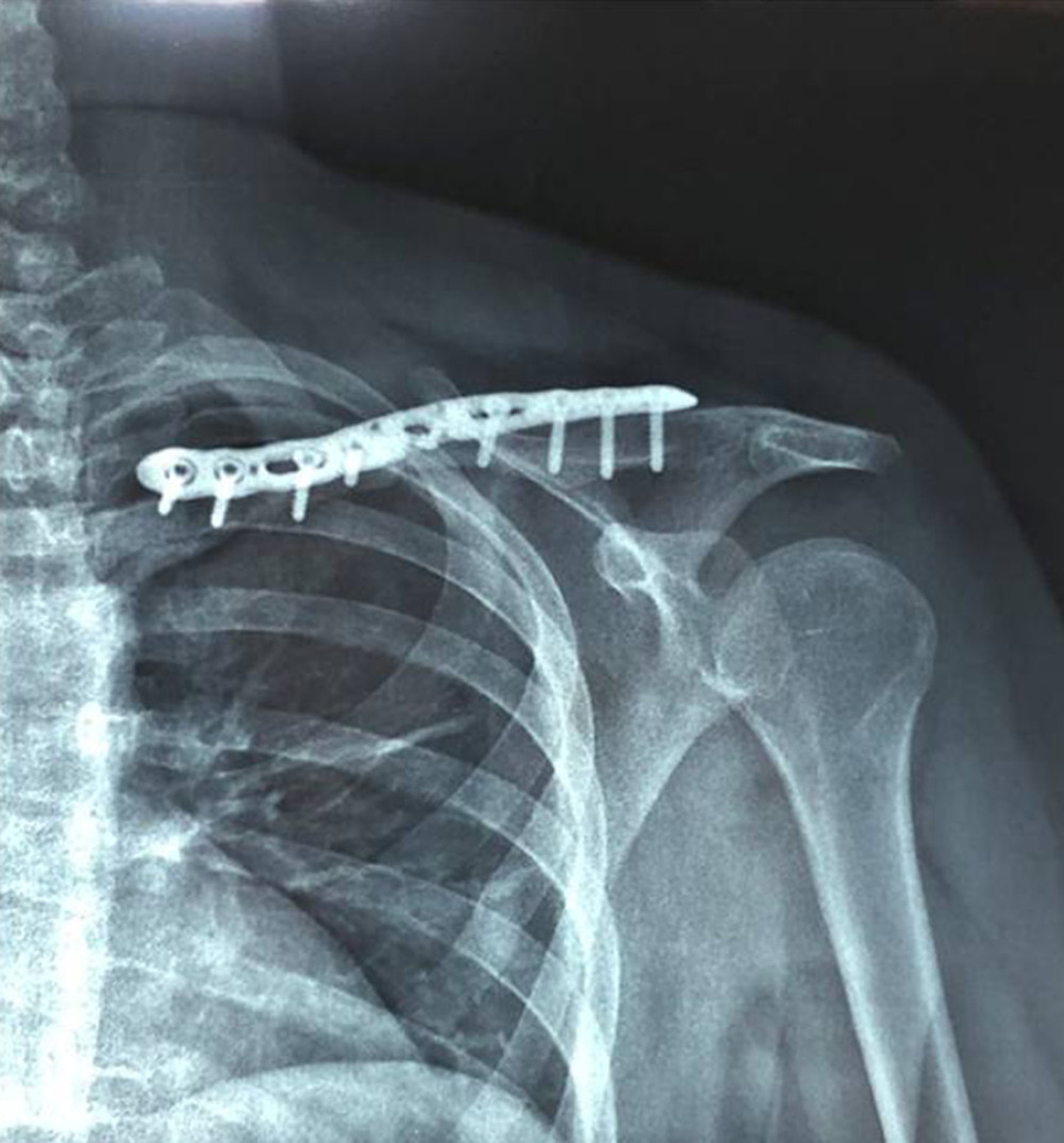 Postoperative X-ray of the clavicle fracture of the first patient.