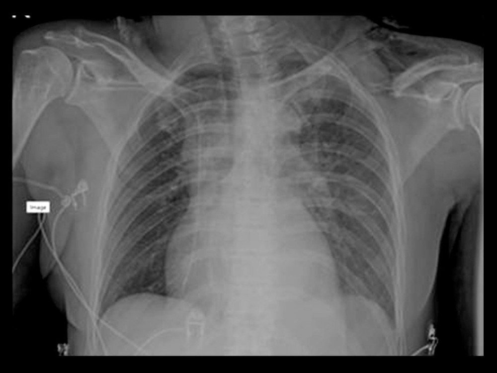 Displaced clavicle fracture of the second patient.