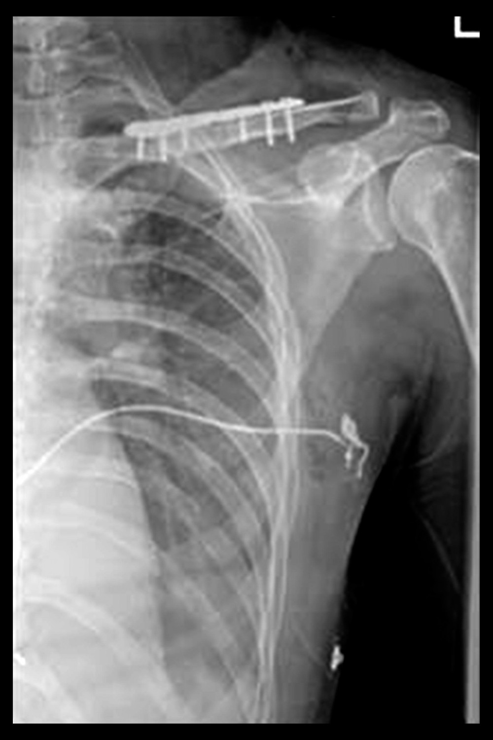 Postoperative X-ray of the clavicle fracture of the second patient.