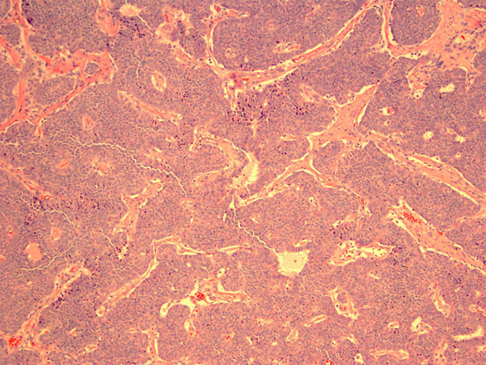Hematoxylin and eosin stains of parathyroid adenoma with morphology indicating neuroendocrine features.