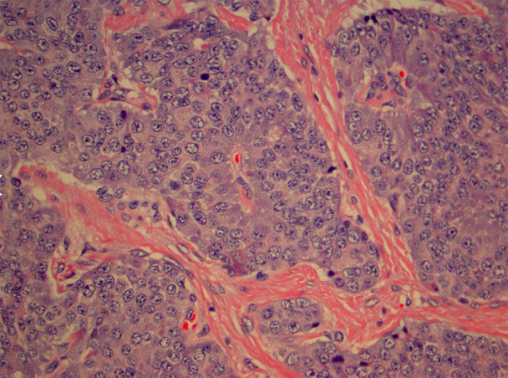Hematoxylin and eosin stains of parathyroid adenoma with morphology indicating neuroendocrine features.