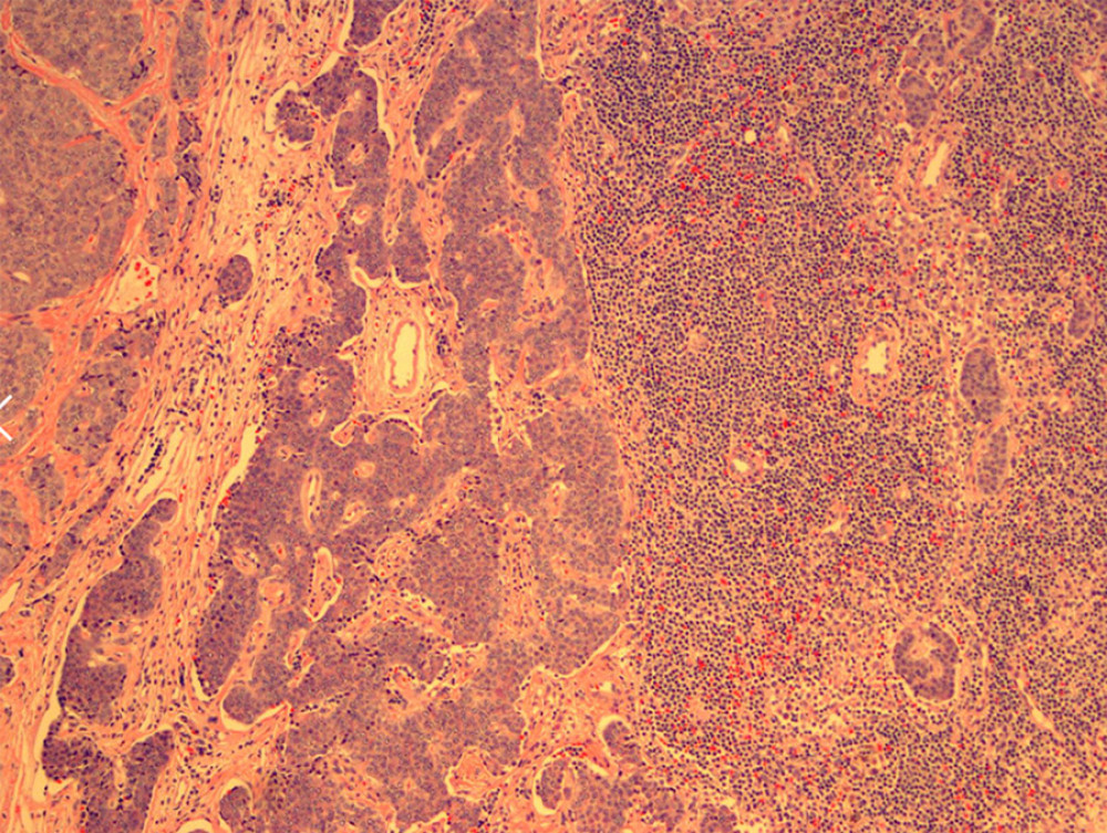 Hematoxylin and eosin stains showing clusters of small blue cells on low-powered fields.