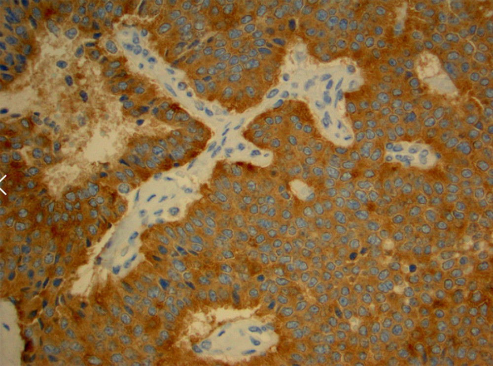 Tumor is positive for chromogranin, indicating neuroendocrine features, which is noted by diffuse uptake of the brown stain.