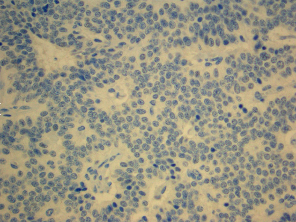 Tumor was negative for PTH and TTF-1; S100, SOX-10, and PAX-8 were all negative. There is an absence of any color uptake beyond the blue cell background.
