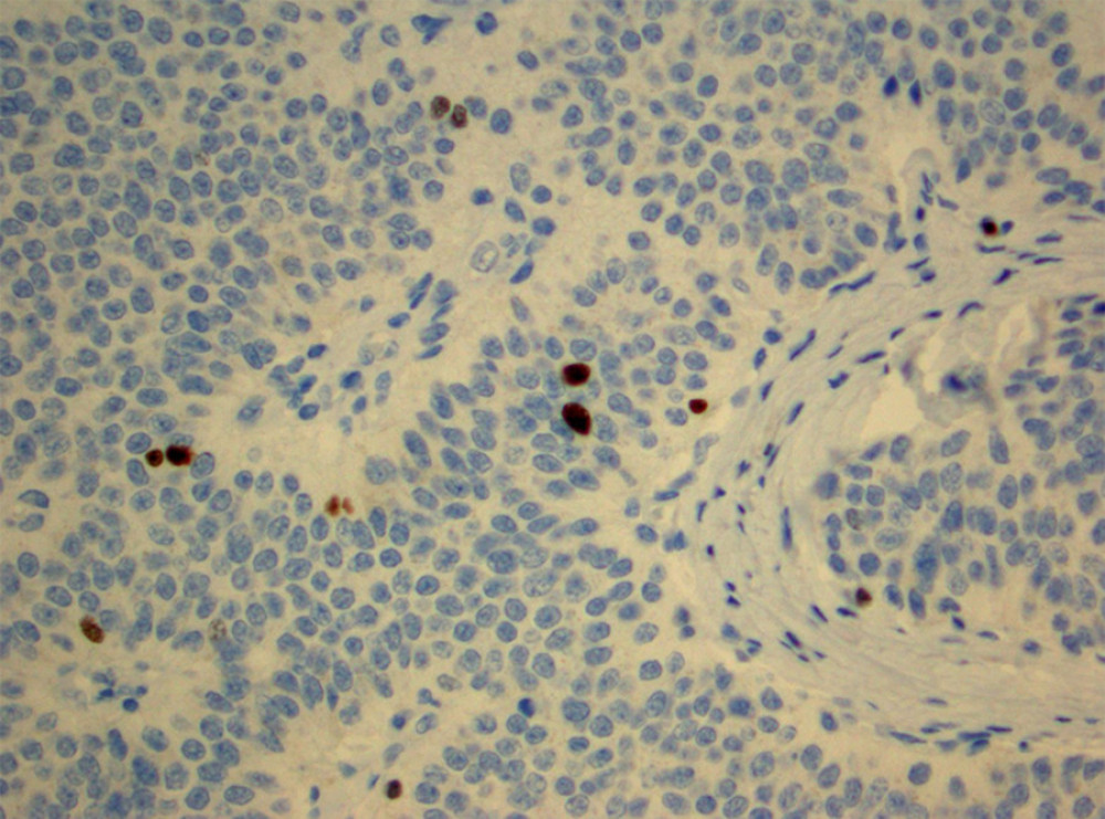 There was a low mitotic index, indicating a grade I neuroendocrine tumor. The Ki-67 index was 2%. This is noted by rare cells taking up the brown stain.