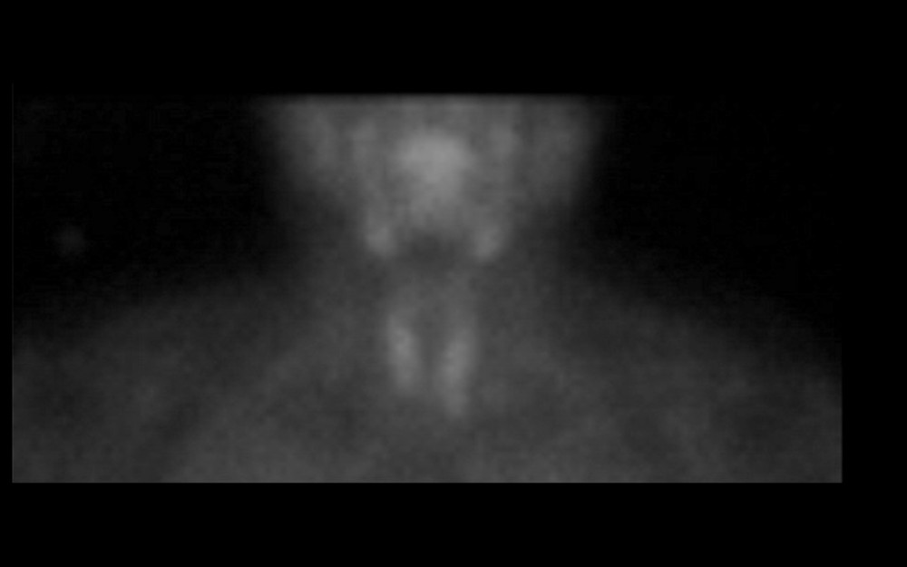 Nuclear medicine (sestamibi) parathyroid scan on October 29, 2019. There was no hyperfunctioning parathyroid adenoma or exogenous parathyroid tissue identified. This was 1 day after parathyroidectomy and mass resection with a persistently elevated PTH level on laboratory evaluation.