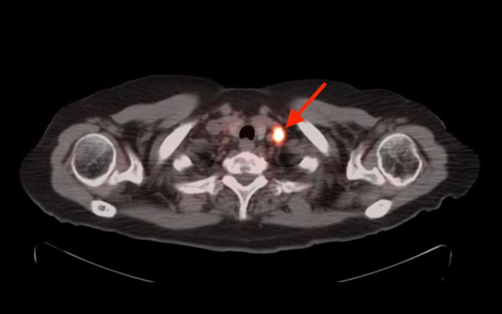 Dotatate PET/CT on December 11, 2019. There are transverse cuts through humoral heads. The arrow indicates increased dotatate uptake, indicating metastatic neuroendocrine tumor.