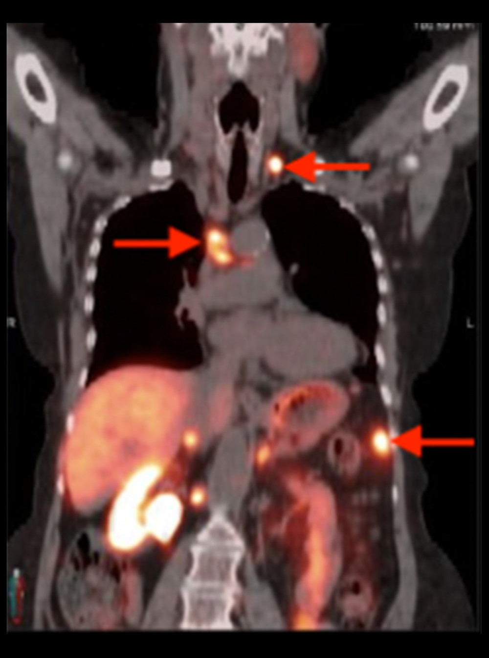 Dotatate PET/CT on December 11, 2019. There are coronal cuts through the mediastinum and posterior abdomen. The arrows indicate dotatate uptake in the parathyroid lymph nodes, mediastinum, and left lateral abdominal mesentery.