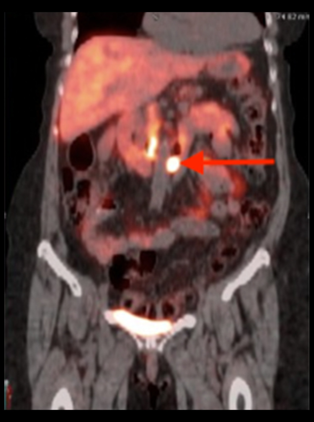 Dotatate PET/CT on December 11, 2019. There are coronal cuts through mid-abdomen. The arrow indicates the area of increased dotatate uptake in para-aortic lymph nodes, indicating widely metastatic neuroendocrine disease.