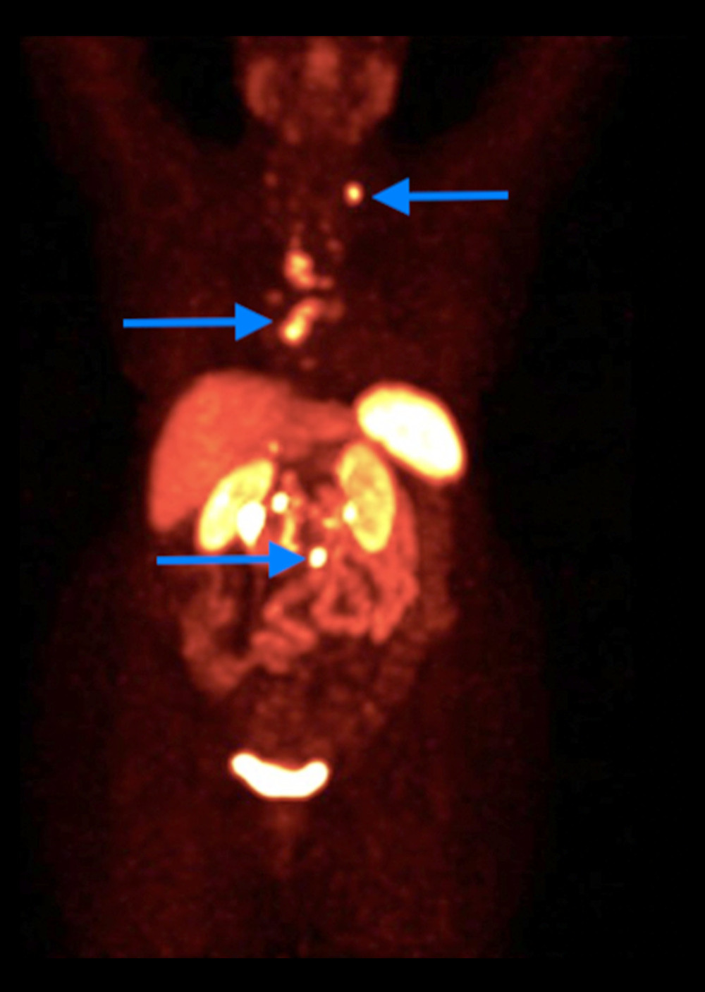 Dotatate PET/CT on December 11, 2019 showing the coronal view of the chest and abdomen without CT overlay. Metastatic uptake of dotatate is noted in parathyroid lymph nodes, mediastinum, intra-abdominal, and para-aortic lymph nodes. The arrows indicate areas of abnormal dotatate uptake, including areas of parathyroid lymph nodes, mediastinal lymph nodes, and para-aortic lymph nodes.