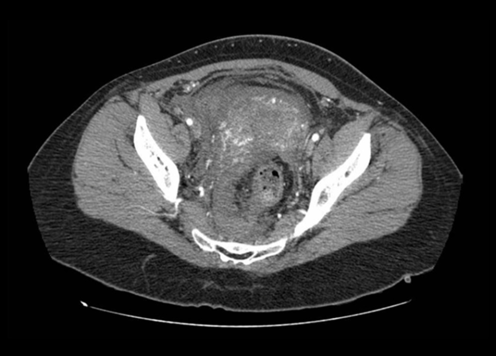 Case 1: abdominal and pelvic computed tomography angiography with contrast. A 10×7-cm hematoma on the right posterolateral wall of the vagina compresses and laterally displaces the rectum.