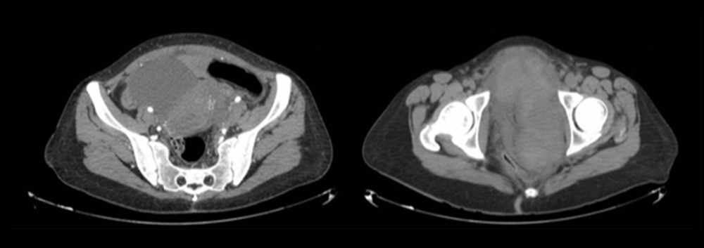 Case 2: abdominal and pelvic computed tomography angiography with contrast. A 16×10×19-cm retroperitoneal hematoma displaces bladder to the right, elevates the uterus, and collapses the sigmoid colon.