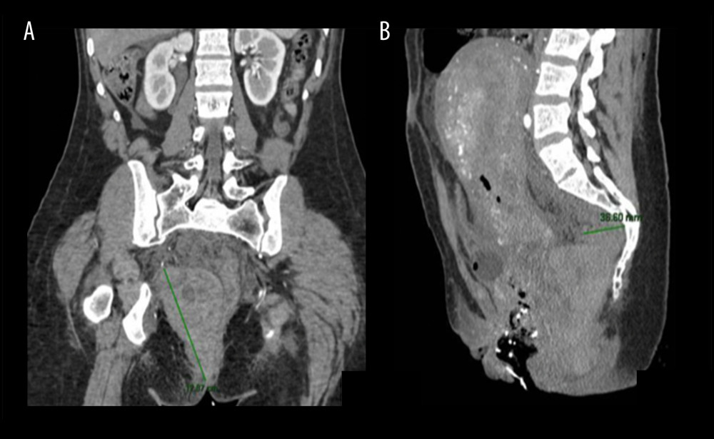 Case 3: abdominal and pelvic computed tomography angiography with contrast. A 6.4×11×13-cm hematoma on the right side of the pelvis displaces the vagina to the right (A). Uterus is increased in size in relation to the recent delivery and the image is compatible with a 3.7-cm blood collection in the presacral space; a gauze-compatible image can be seen inside the vagina (B).