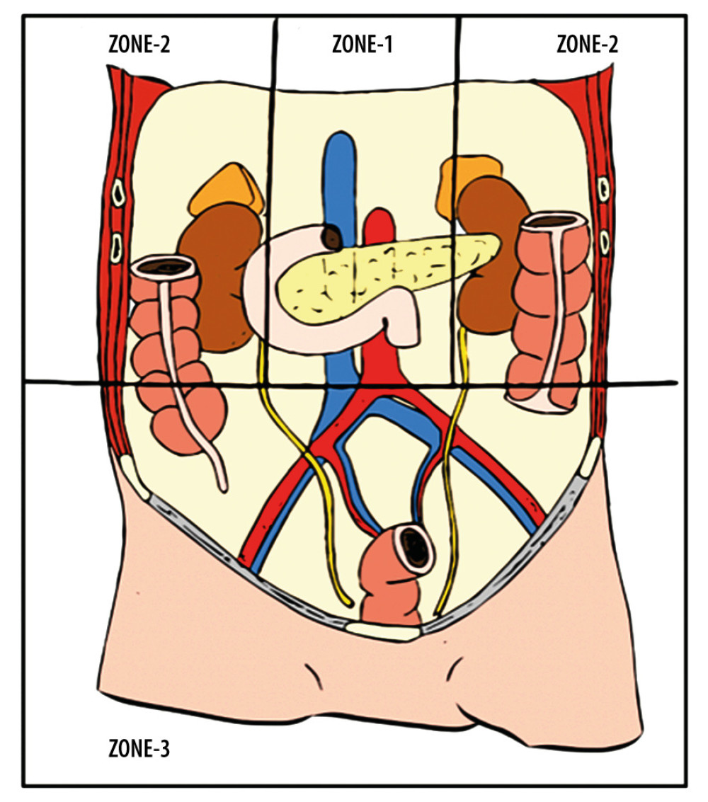 Retroperitoneum division zones: Zone 1: initial surgical management. Zones 2 and 3: conservative treatment can be chosen in certain situations. (Redondo et al).