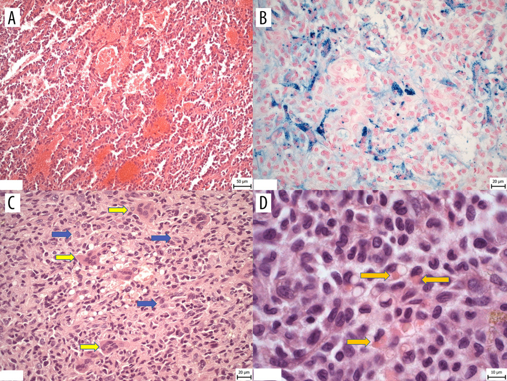 Representative histopathology images. (A) The vasoformative and reticular growth patterns of tumor with vascular-like spaces filled with erythrocytes. (B) Deposits of hemosiderin pigment in siderophages in fibrous neoplastic stroma of tumor (iron Perls staining). (C) Solid growth patterns of tumor consisting of neoplastic cells with occasional larger cells of round-to-oval shape, with abundant eosinophilic cytoplasm (marked by blue arrows) and osteoclast-like cells (marked by yellow arrows) (HE, magnification 40×). (D) Higher magnification of neoplastic cells showing round-to-oval nuclei with irregular folds and hemophagocytosis in occasional neoplastic cells (indicated by arrows) (HE, magnification 100×).